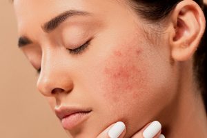 how to prevent acne ?