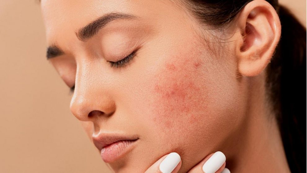 how to prevent acne ?